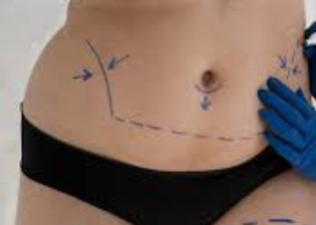 Professional Liposuction Surgery in Istanbul — A Smart Guide for First-Time Medical Travelers